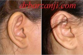جراحی لاله گوش