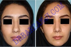 جراحی بینی ، ٣ ماه بعد از عمل