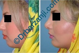 پروتز چانه و گونه سه هفته بعد از عمل
