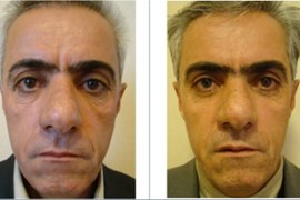 عمل جراحی پلک (بلفاروپلاستی) فوقانی