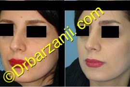 جراحی بینی سه ماه بعد از عمل
