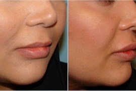 ژل جوویدرم، لب بالا