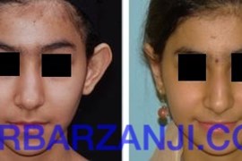 عمل جراحی لاله گوش برجسته
