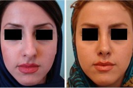 جراحی پلاستیک بینی٣ سال بعد از عمل