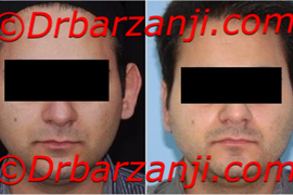 جراحی برجستگی گوش یک ماه بعد از عمل