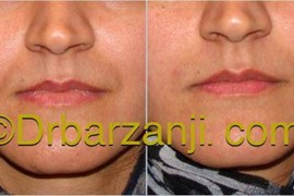 تزریق ژل در خط خنده