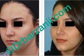 عمل جراحی پلاستیک بینی یک سال بعد