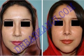 جراحی بینی، ۶ ماه بعد از عمل