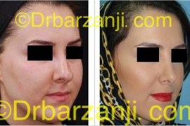 عمل جراحی زیبایی بینی یک سال بعد