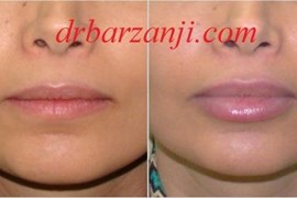 تزریق ژل جوویدرم در لب