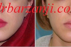 تزریق ژل برای بهبود غیر قرینگی فک