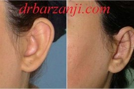 جراحی لاله گوش