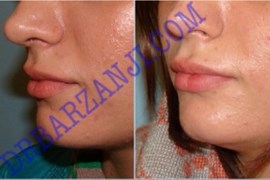 تزریق ژل ژوویدرم به لب ، ٤ ماه بعد