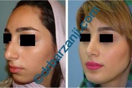  جراحی بینی و پروتز چانه چهار سال بعد از عمل