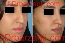 عکس عمل جراحی پلاستیک بینی ۶ ماه بعد