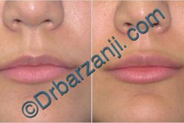 تزریق جوویدرم به لب سه هفته بعد