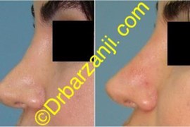 تزریق ژل رستیلن در بینی عمل شده