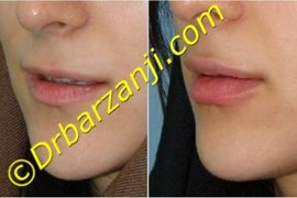 تزریق ژل لب