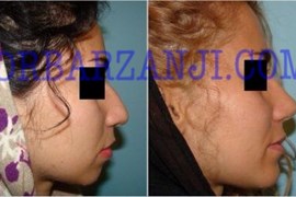 پروتز چانه و جراحی بینی، یک سال بعد از عمل