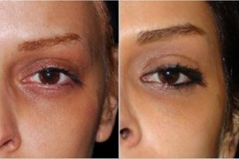 تزریق ژل زیر چشم