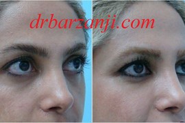 تزریق چربی زیر چشم ها
