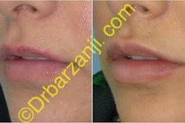تزریق ژل جوویدرم  ( ژوویدرم ) به لب یک هفته بعد