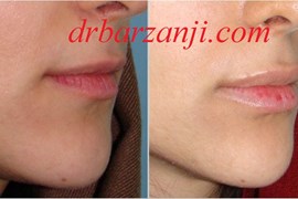 تزریق فیلر ژوویدرم در لب