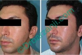 پروتز چانه دو هفته بعد از عمل