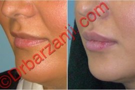 تزریق ژل جوویدرم  ( ژوویدرم ) به لب پانزده ماه بعد
