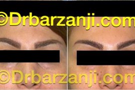 قرینه کردن ابروها با بوتاکس ( دیسپورت )