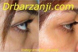تزریق ژل رستیلن زیر چشم