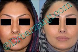 عمل جراحی پلاستیک بینی ( رینوپلاستی )