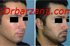 پروتز چانه یک هفته بعد از عمل
