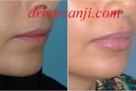 تزریق ژل جوویدرم در لب