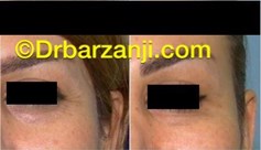 کاهش خطوط کنار چشم در هنگام خنده با تزریق بوتاکس ( دیسپورت )