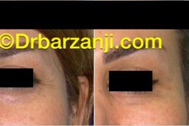 کاهش خطوط کنار چشم در هنگام خنده با تزریق بوتاکس ( دیسپورت )