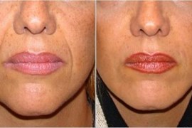 تزریق ژل جوویدرم در خط خنده