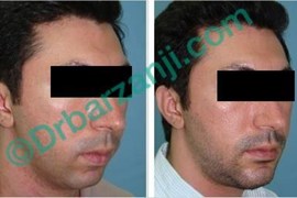 پروتز چانه دو هفته بعد از عمل