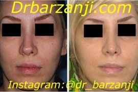 جراحی ترمیمی بینی دو هفته بعد از عمل