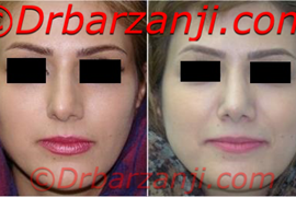 عکس قبل و بعد جراحی پلاستیک بینی شش ماه بعد