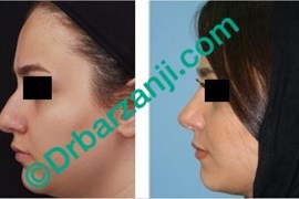 عمل جراحی پلاستیک بینی یک سال بعد