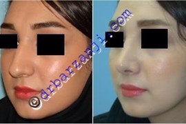  جراحی پلاستیک بینی یک سال بعد از عمل