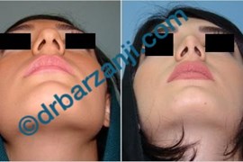 جراحی بینی یک سال و نیم بعد از عمل