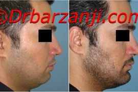 پروتز چانه یک هفته بعد از عمل