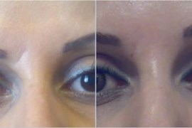 تزریق ژل در ناحیه خط اخم