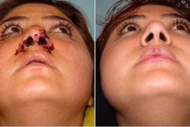 پارگی و شکستگی بینی 9