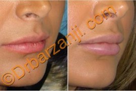 تزریق ژل جوویدرم  ( ژوویدرم ) به لب یک ماه بعد