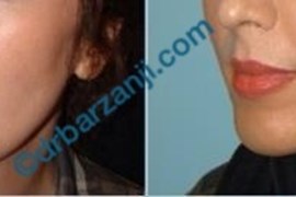 عمل جراحی پروتز چانه