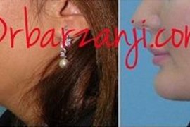 پروتز چانه و لیپوساکشن غبغب