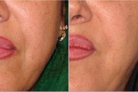 تزریق ژل جوویدرم در خطوط اطراف لب و بینی، ٦ ماه بعد